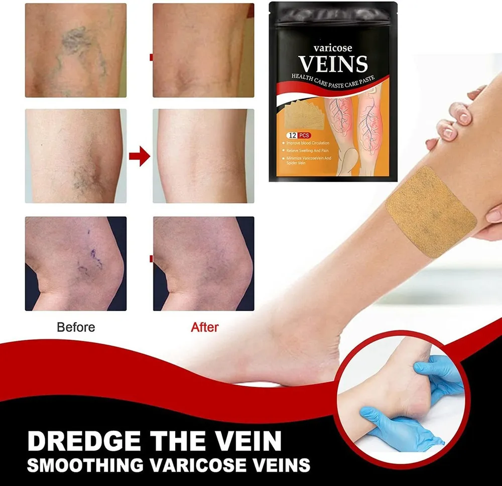 🦵 Pack Oferta: 4x1 Parches ADIÓS VÁRICES 🦵