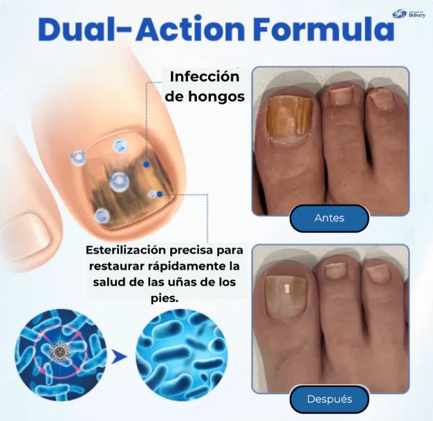 PACK 2X1 - ELIMINA EL HONGO DE TUS UÑAS