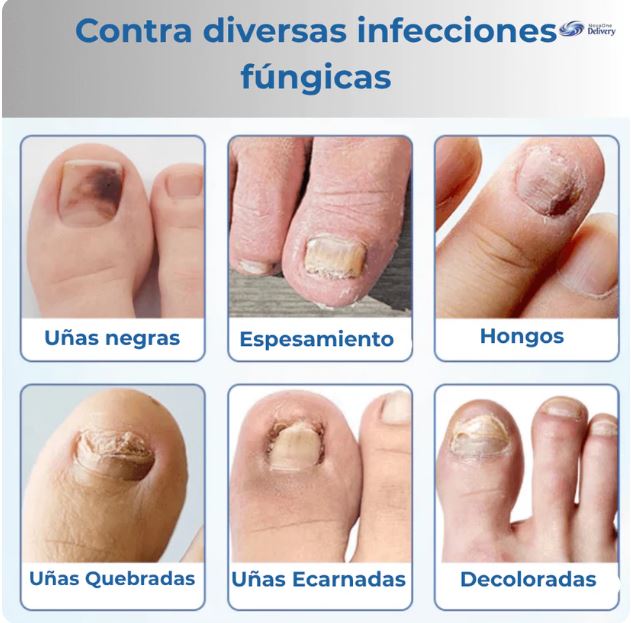 PACK 2X1 - ELIMINA EL HONGO DE TUS UÑAS